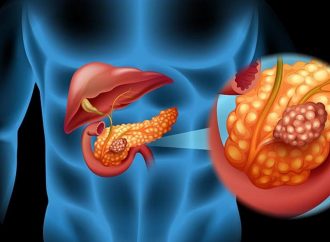 <strong>Avance médico.</strong> Equipo médico de Israel desarrolla tratamiento para el cáncer de páncreas