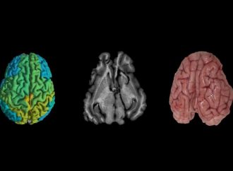 <strong>Universidad Hebrea de Jerusalem.</strong> La técnica de imagen israelí podría ayudar a los médicos a predecir el Alzheimer y el cáncer