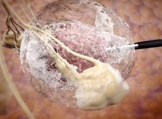 <strong>﻿Ataca sólo a las células malignas.</strong> Startup israelí desarrolla tecnología para tratar tumores sólidos internos