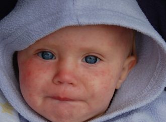 <strong>Alerta.</strong> Brote de sarampión en seis ciudades israelíes: cuatro niños en cuidados intensivos y uno en ECMO