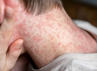 Un bebé de once meses se convierte en la decimotercera víctima del brote de sarampión en Israel