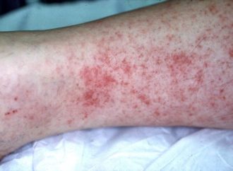 Alerta sanitaria en Sharon: Varios niños diagnosticados con fiebre maculosa transmitida por garrapatas
