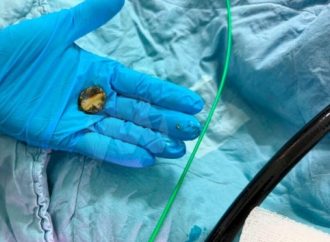 Milagro médico: Un niño de Jerusalem se salva tras tragarse una pila de botón