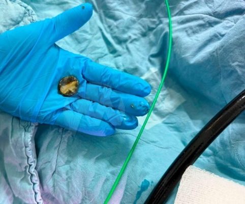 Milagro médico: Un niño de Jerusalem se salva tras tragarse una pila de botón